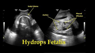 Hydrops Fetalis  Ultrasound  Anomaly  Case 26 [upl. by Hartzke]