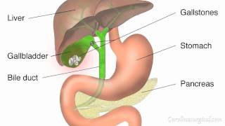 Gallbladder Removal Surgery Animation [upl. by Gillie]