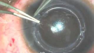 Intacs Insertion for Keratoconus [upl. by Yolande]