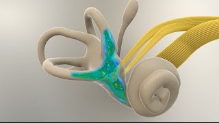 Menieres Disease  What Happens in the Inner Ear [upl. by Aryn]